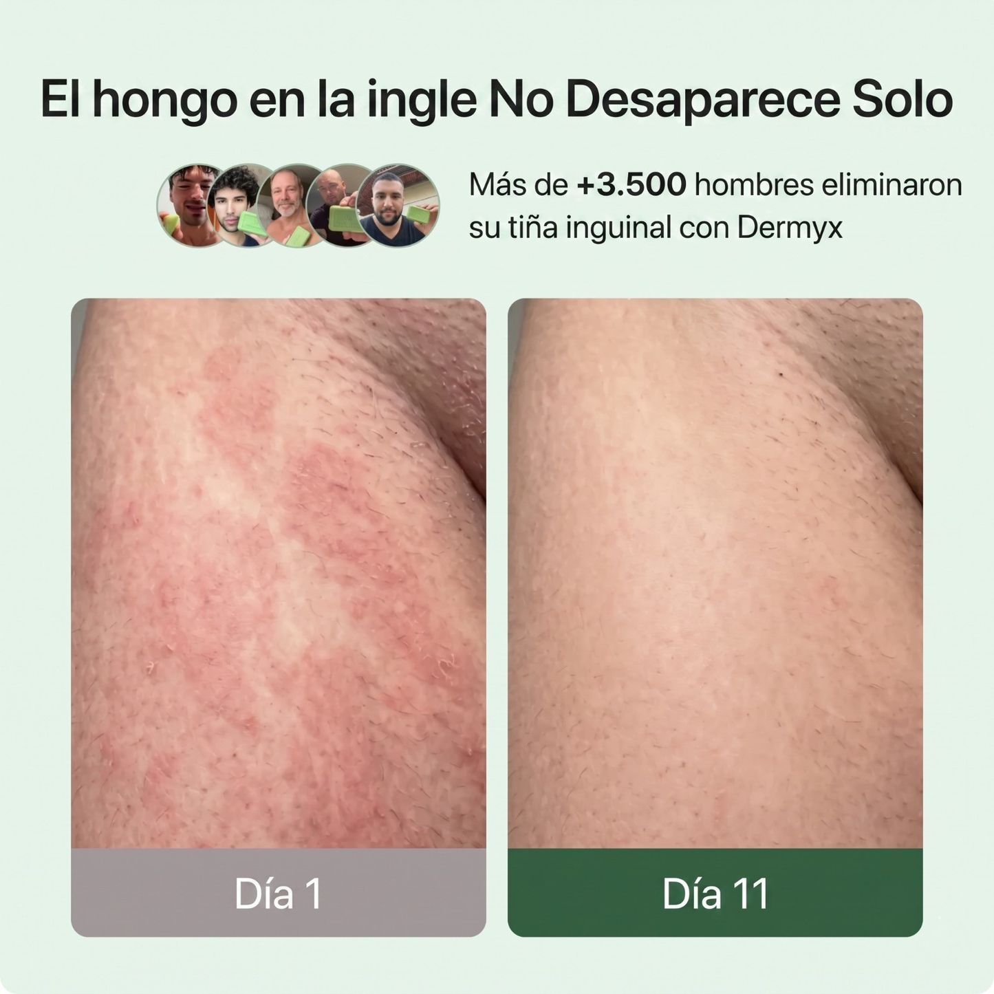 Dermyx® — Jabón Antifúngico